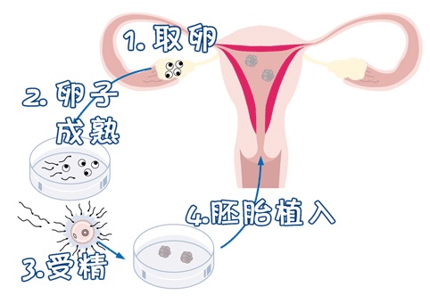 42岁PGT成功案例
